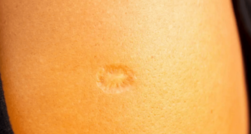 The Story Behind the Smallpox Scar