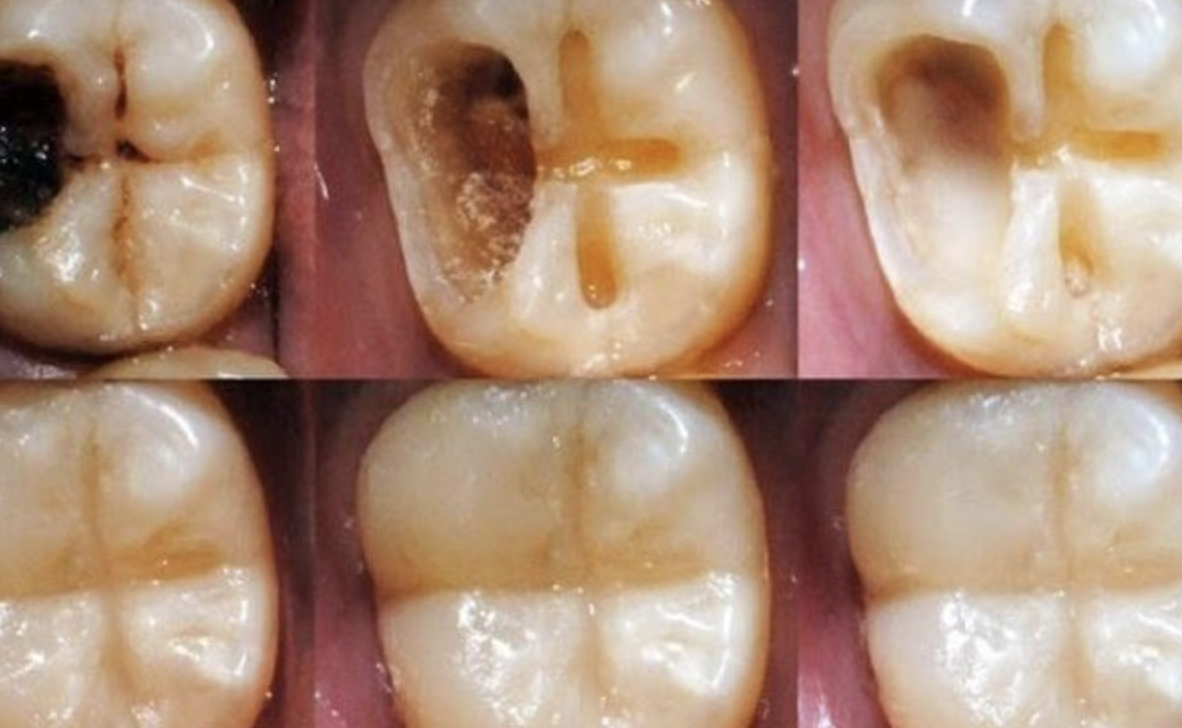 A Balanced Diet for Strong Teeth