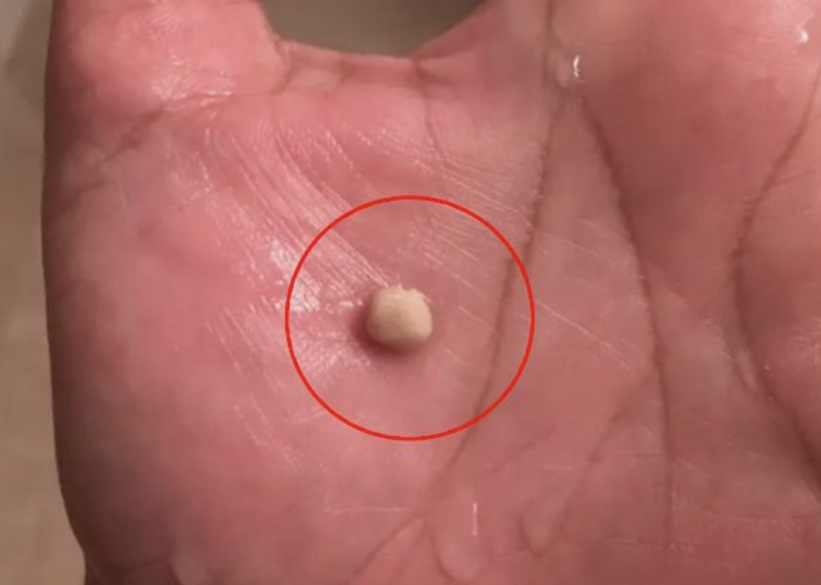 The Strange Fascination with Tonsil Stone Removal